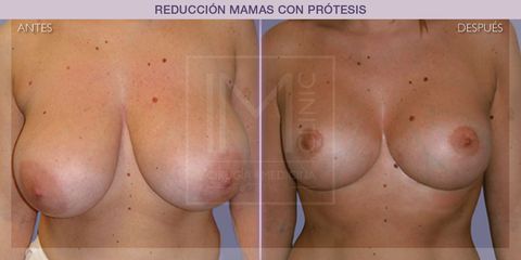 Reducción mamas - IM CLINIC