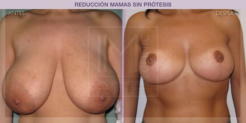 Reducción mamas - IM CLINIC