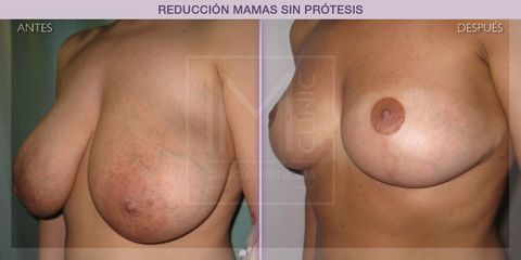 Reducción mamas - IM CLINIC
