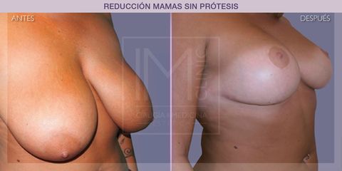 Reducción mamas - IM CLINIC