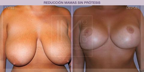 Reducción mamas - IM CLINIC