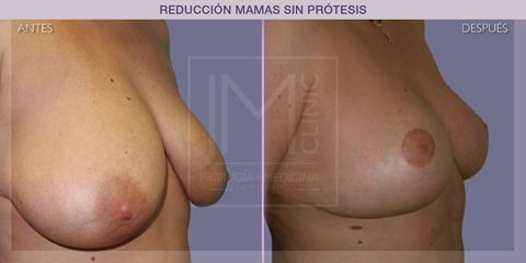 Reducción mamas - IM CLINIC