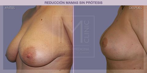 Reducción mamas - IM CLINIC
