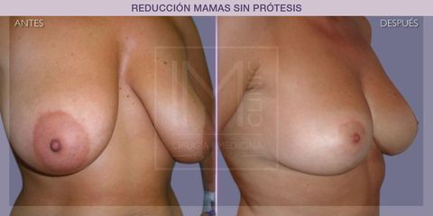 Reducción mamas - IM CLINIC
