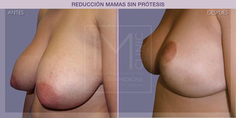 Reducción mamas - IM CLINIC
