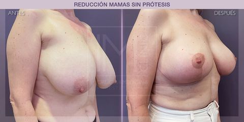Reducción mamas - IM CLINIC