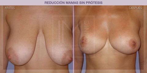 Reducción mamas - IM CLINIC
