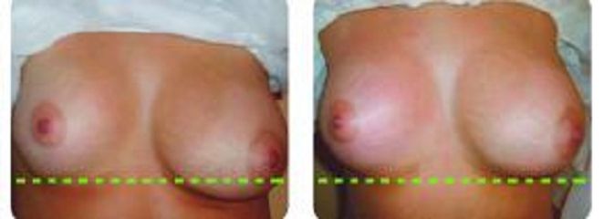 Antes y después Mastopexia 
