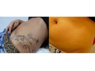 Antes y después Eliminación de tatuajes