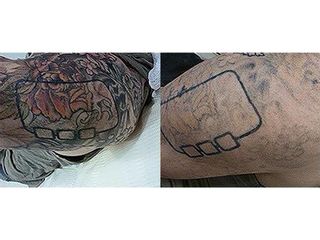 Antes y después Eliminación de tatuajes