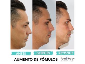 Aumento pómulos - 645577