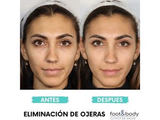 Eliminación ojeras - 645578