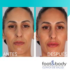 Antes y después Aumento de labios - Foot And Body