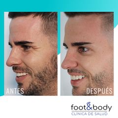 Antes y después Bótox - Foot And Body