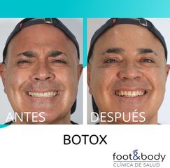 Bótox - Foot And Body