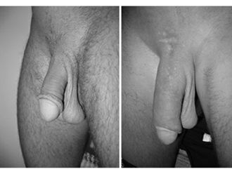 Alargamiento de pene - 490470