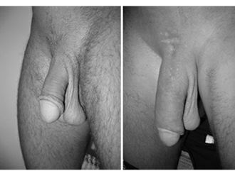 Alargamiento de pene antes y después - 490470