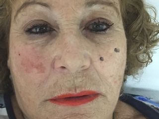 Lifting de tercio medio facial. Lado derecho.