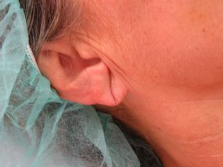 Bioplastia lóbulo de la oreja.