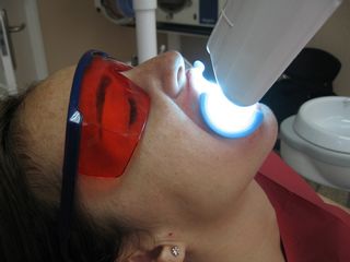 Fase de blanqueamiento dental.
