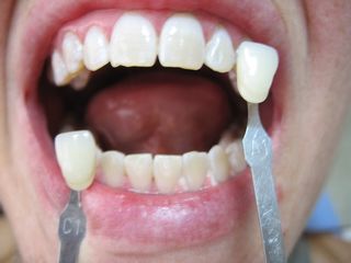 Resultado final del blanqueamiento dental