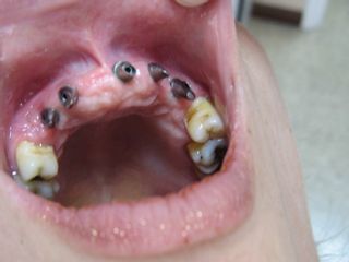 Rehabilitación implanto soportada anterior.
