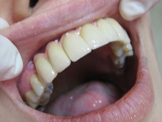 Prótesis sobre implantes colocada.  