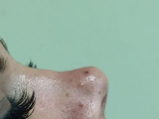 Bioplastia de perfil nasal