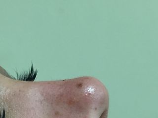 Bioplastia del perfil nasal. Resultado final