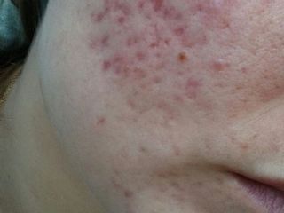 TRATAMIENTOS ANTIAACNÉ