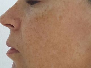 aumento labios