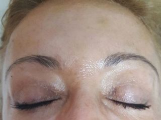 rejuvenecimiento facial