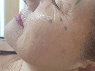 PREPARADA PARA REJUVENECIMIENTO FACIAL