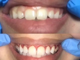 Corrección de la sonrisa gingival mediante gingivoplastia