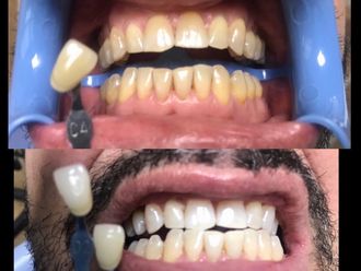 Blanqueamiento dental - 634029