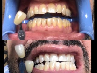 Blanqueamiento dental láser