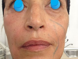 Lipotransferencia facial