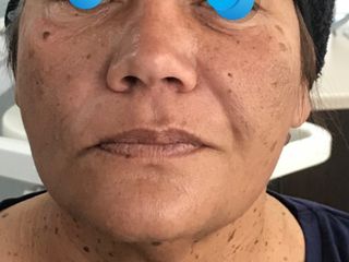 Lifting cérvicofacial  láser no quirúrgico