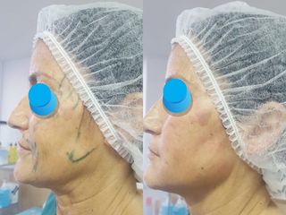Rejuvenecimiento facial full face con grasa propia
