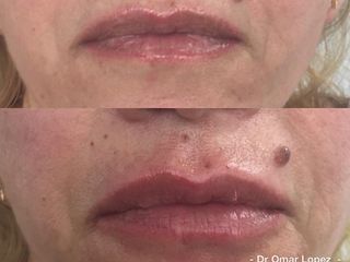 Aumento remodelación  labial con hialurónico