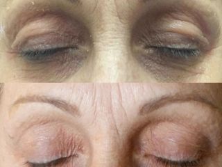 Blefaroplastia NO quirúrgica