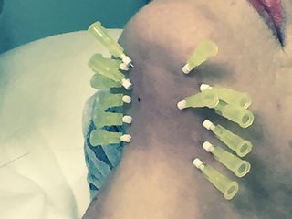 Hilos tornados para mejora de la flacidez cervical