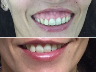 Corrección de la sonrisa gingival con botox y ac hialurónico