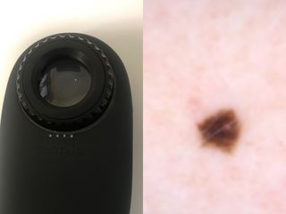Estudio y seguimiento de lunares y lesiones de la piel por dermatoscopio