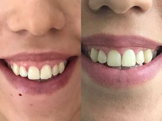 Corrección de sonrisa gingival con bótox y relleno con ac hialurónico