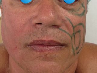 Rejuvenecimiento facial full face en hombres. Masculinización facial.
