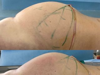 Remodelación glútea con aumento de la porción inferior solamente 