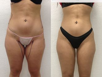 Lipoescultura - 637190