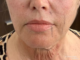 Lifting cérvico facial láser. Comparativa lado derecho de la paciente realizado vs izquierdo  sin