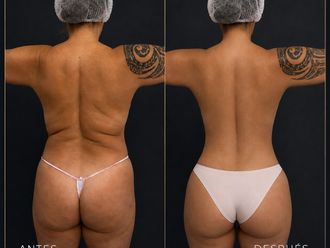 Lipoescultura antes y después - 880992